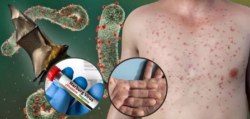 Tanzanya’da Marburg virüsü salgını